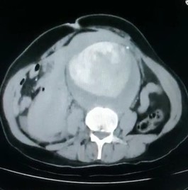 CT-Scan-Abomen-aneurysm.jpg