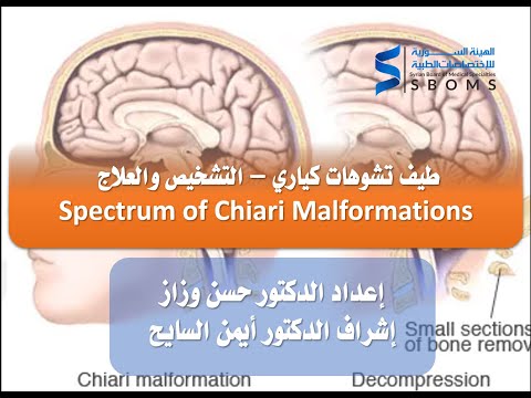 طيف تشوهات كياري التشخيص والعلاج